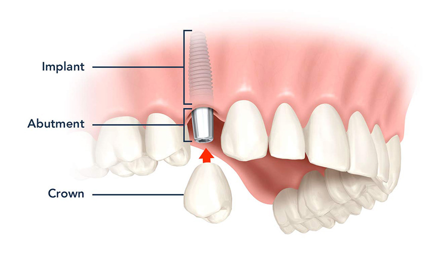 What is a dental implant to replace a tooth?