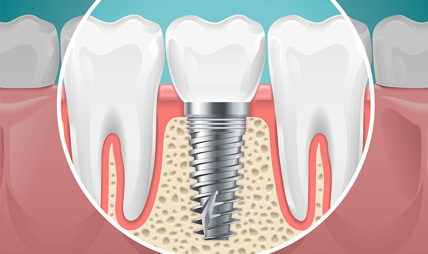 How much do dental implants cost?