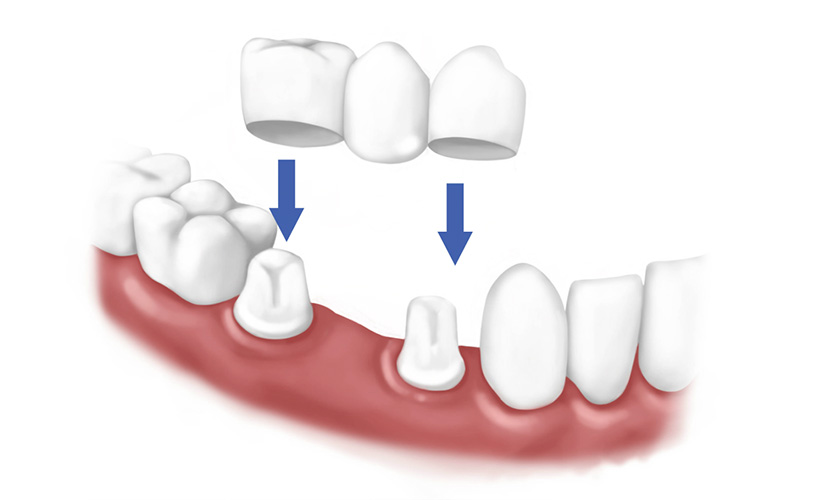 Dental bridge