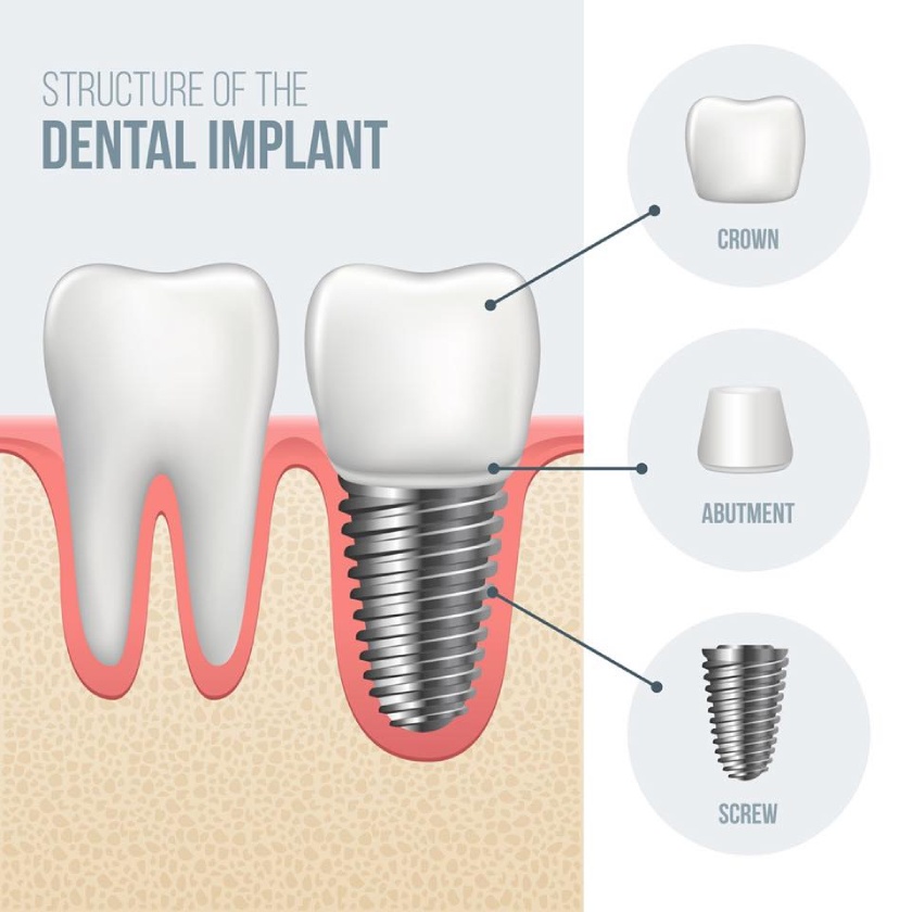 Why should I choose dental implant instead of dental bridge?