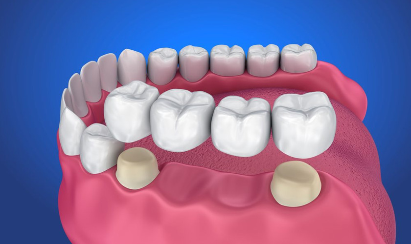 Why should I choose dental implant instead of dental bridge?