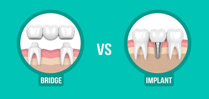 Why should I choose dental implant instead of dental bridge?