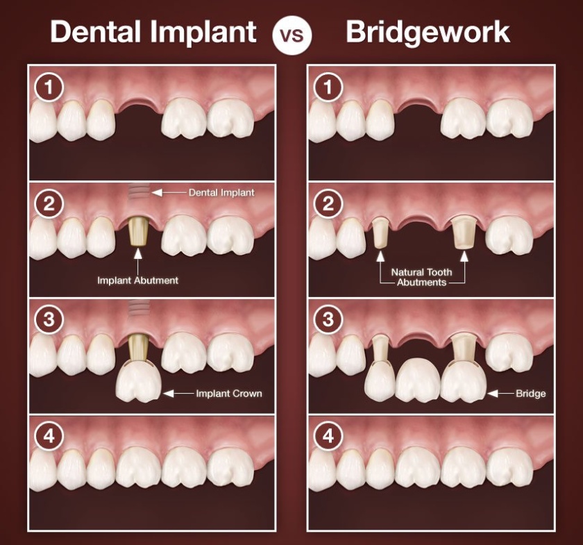 Why should I choose dental implant instead of dental bridge?