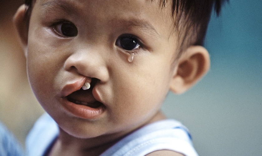 Cleft lip-palate is a birth defect that gives children many difficulties in daily life