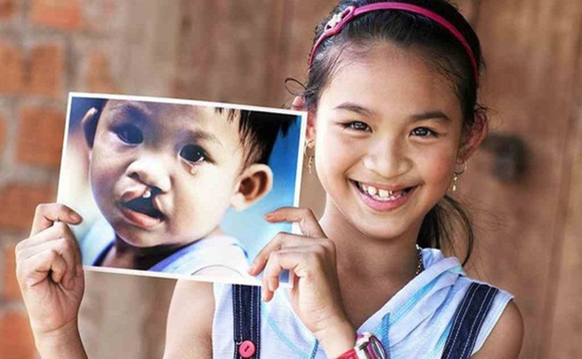 Cleft lip-palate is a birth defect that gives children many difficulties in daily life