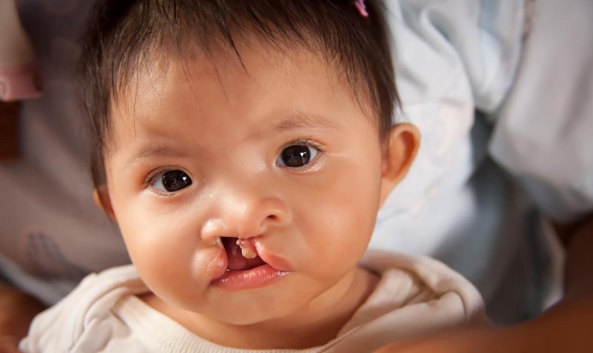 Cleft lip and cleft palate