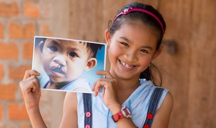 Cleft lip and cleft palate