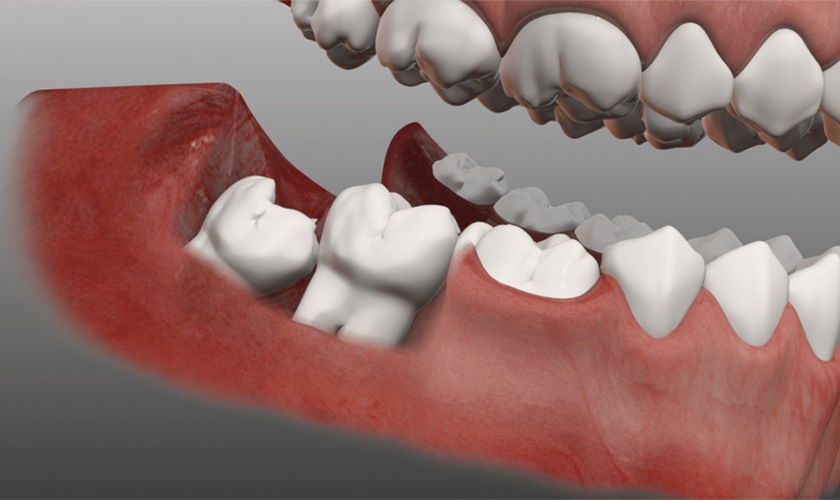 Chi phí nhổ Tooth khôn phụ thuộc vào độ khó của Tooth Chi phí nhổ Tooth khôn phụ thuộc vào độ khó của Tooth