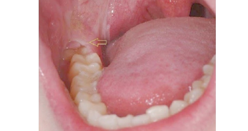 Tình trạng lợi trùm Tooth khôn