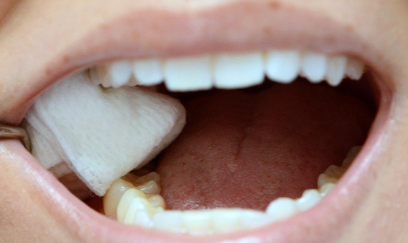 Cần phải cắn chặt gạc sau khi nhổ Tooth khôn Cần phải cắn chặt gạc sau khi nhổ Tooth khôn