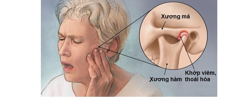 Viêm xương hàm là một trong những biến chứng ít gặp sau khi nhổ Tooth khôn