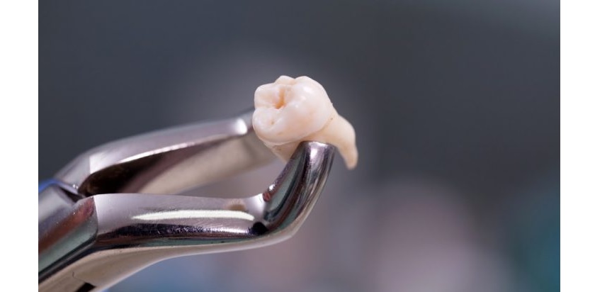 Nhổ Tooth khôn không gây hại gì cho sức khoẻ Tooth miệng và sức khoẻ tổng quát
