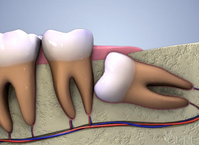 Nhổ răng khôn có ảnh hưởng đến thần kinh không? Những lưu ý cần biết trước khi quyết định