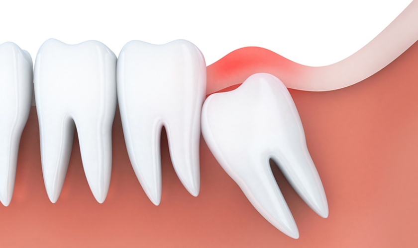 Viêm lợi trùm Tooth khôn Viêm lợi trùm Tooth khôn