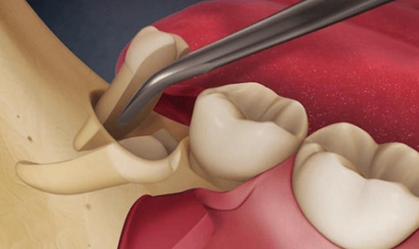 Tooth khôn mọc lệch nên nhổ bỏ Tooth khôn mọc lệch nên nhổ bỏ