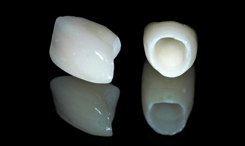 All-ceramic teeth are made entirely from pure porcelain