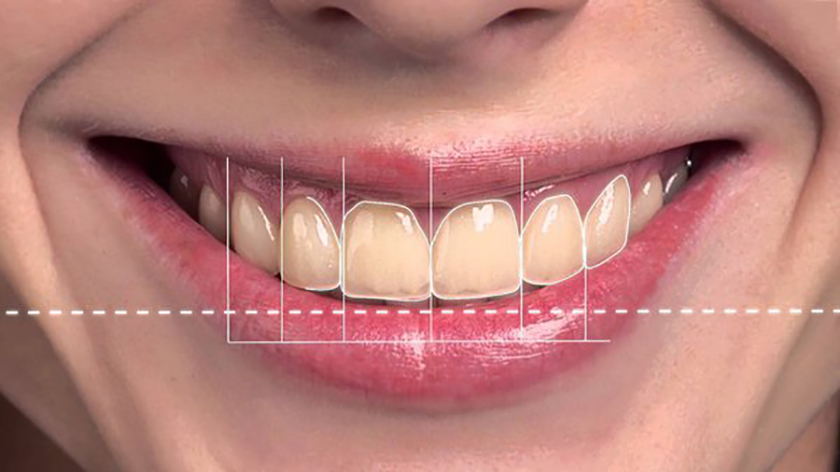 Beautiful smile design with dental crowns and veneers