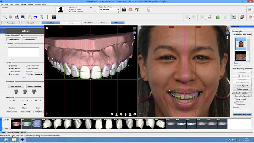 Smile designs are performed entirely on specialized analysis software, giving the most accurate result