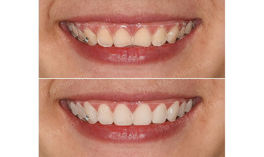 A customer who had crown treatment with smile design at Nhan Tam Dental