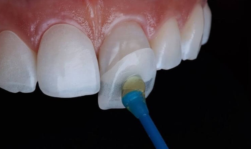 Cercon® Zirconia Systems