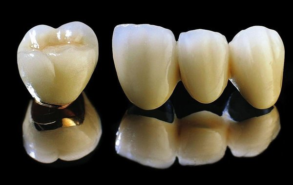 Porcelain fused to metal crowns