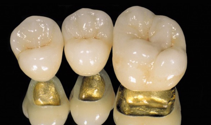 Gold crowns