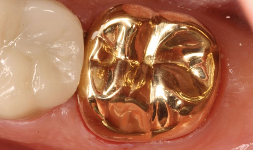 Gold crowns