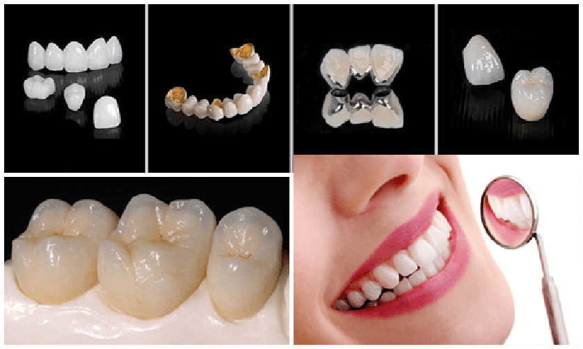 Depend on cosmetic needs as well as dental condition, a patient can choose the appropriate type of crown