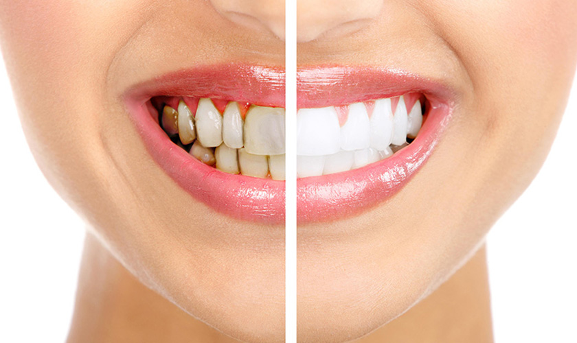 Dental crown restoration for antibiotic-stained teeth