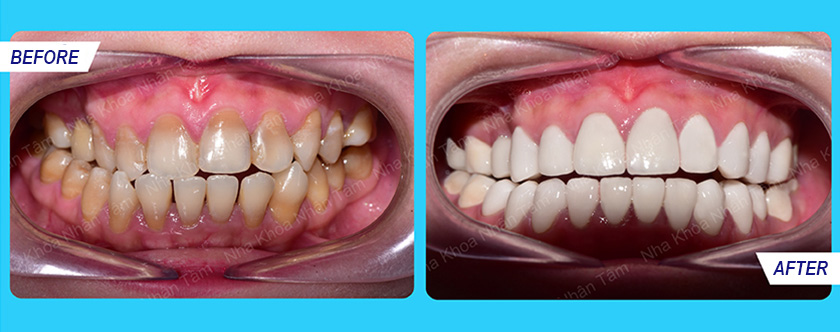 A patient with worn teeth with antibiotic stain