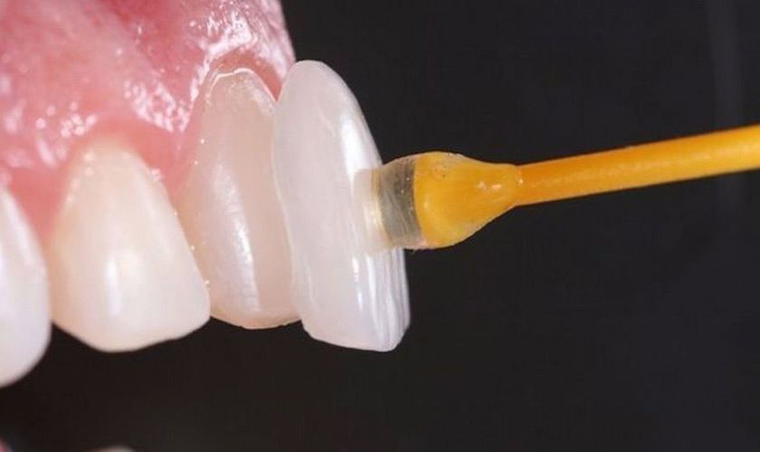 How long does it take to make porcelain veneer?
