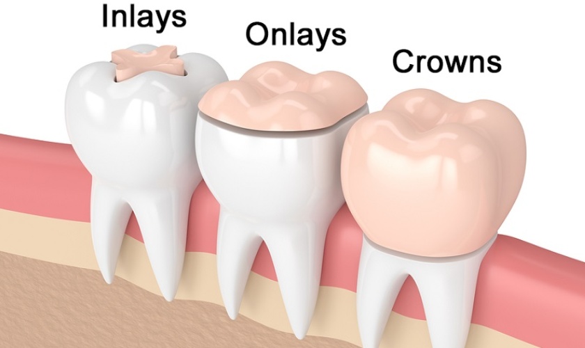 Inlay and onlay