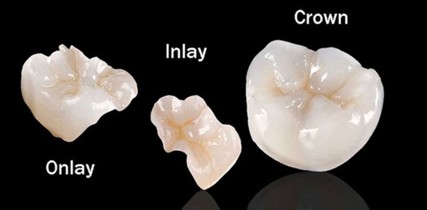 Inlay and onlay