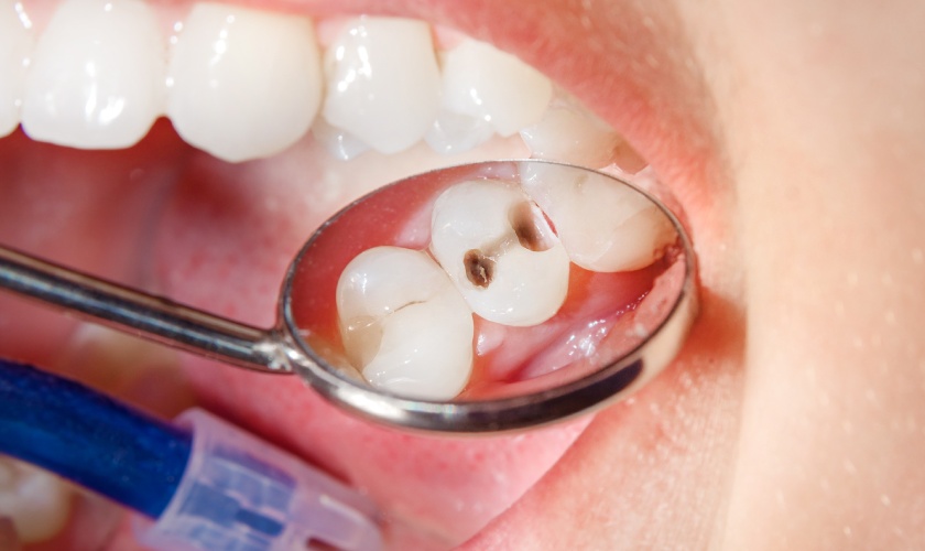 Is placing dental crown over decayed teeth good?