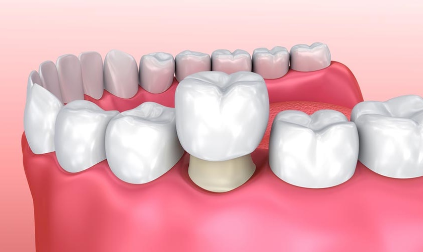 4. Nhược điểm của bọc sứ