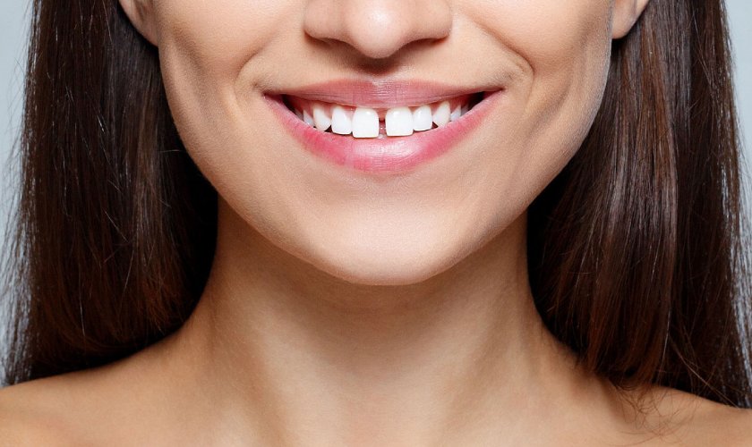 Slightly gap teeth are very suitable for porcelain crowns