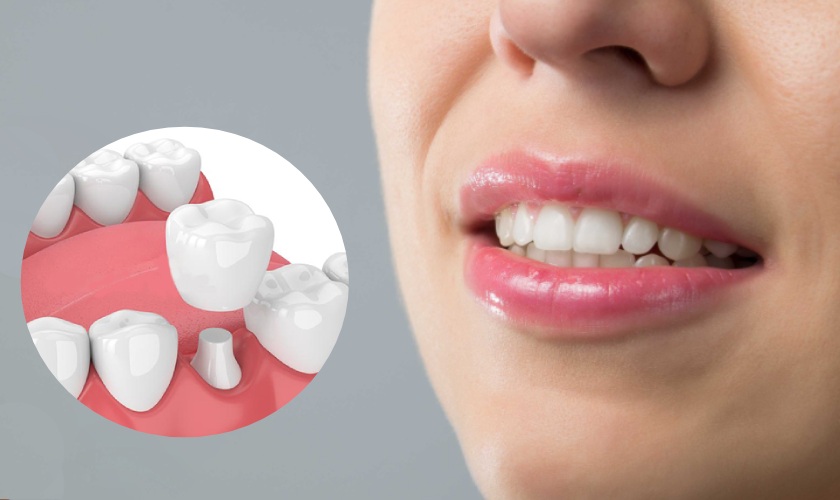 Tooth sứ khắc phục tình trạng Tooth hô ở mức độ nhẹ