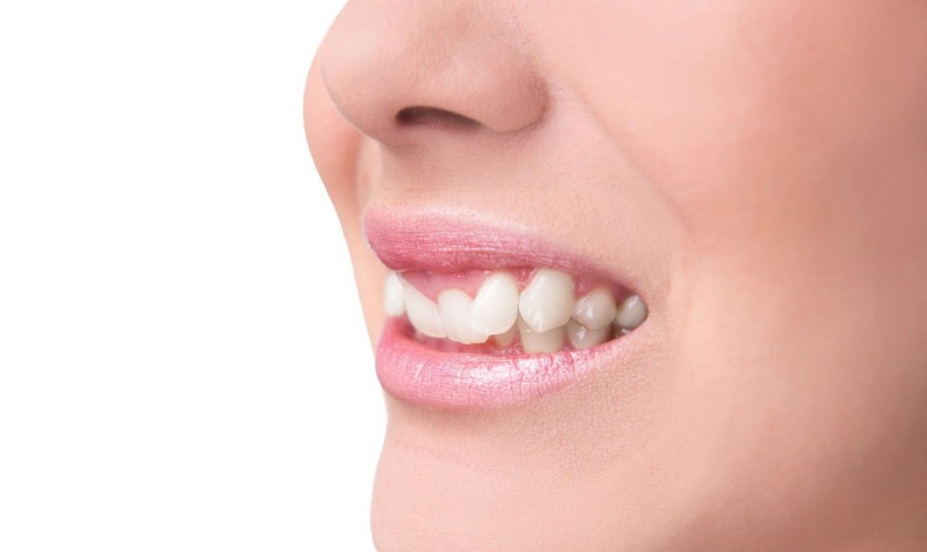 Tooth lệch lạc nhẹ bọc Tooth sứ để cải thiện thẩm mỹ