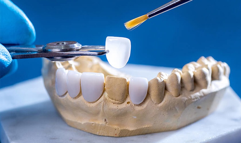 Mặt dán sứ Veneer hạn chế tối đa mài Tooth