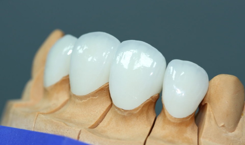 Tooth sứ Lava Esthetic là dòng sứ cao cấp hiện nay