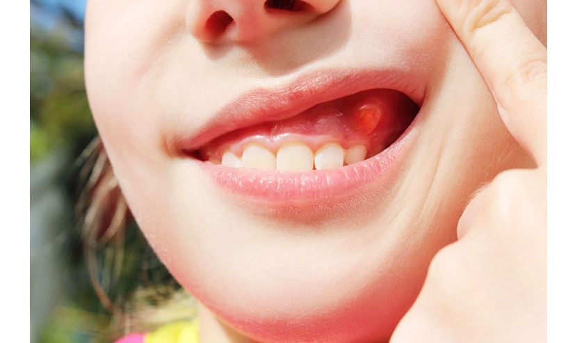 Tooth sứ giá rẻ có thể gây ra các vấn đề về Tooth miệng