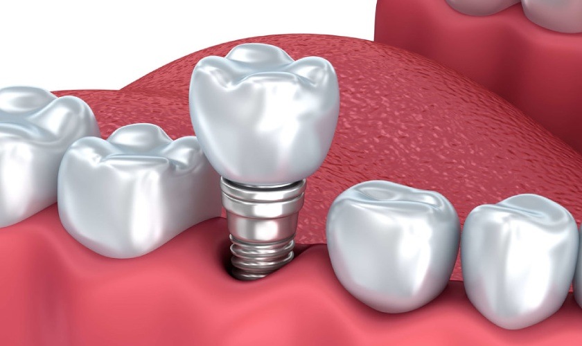 Tooth sứ trên implant có độ bền chắc rất cao