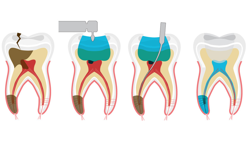 Curettage plays an important role in cosmetic dental prosthetics