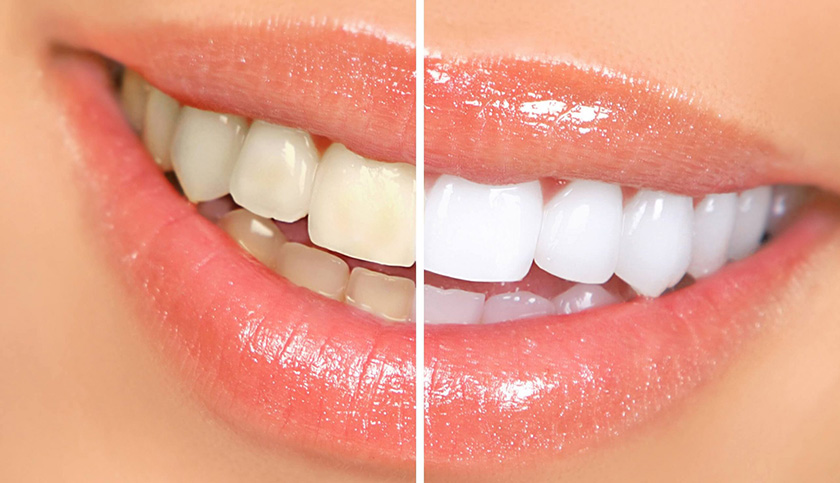 Price of porcelain crowns