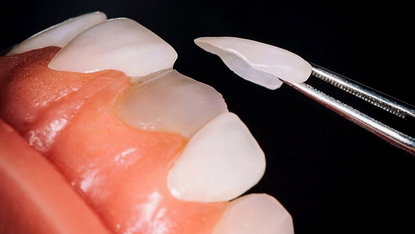 Porcelain Veneer will help you to have a beautiful and permanent smile