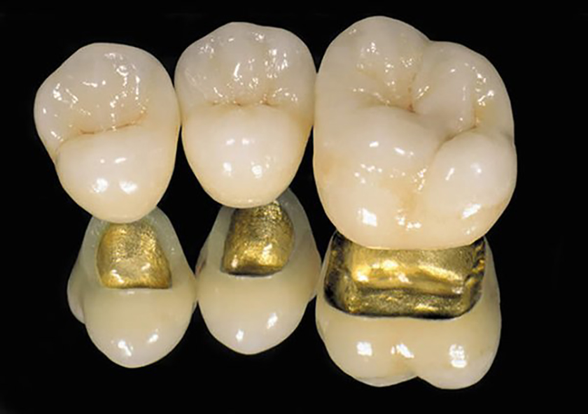 Dental porcelain precious metal