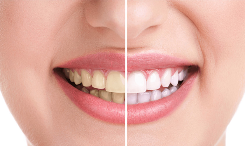 Restoring discolored teeth with Veneer