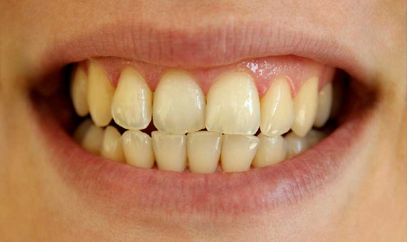 Cases should be made of Veneer porcelain