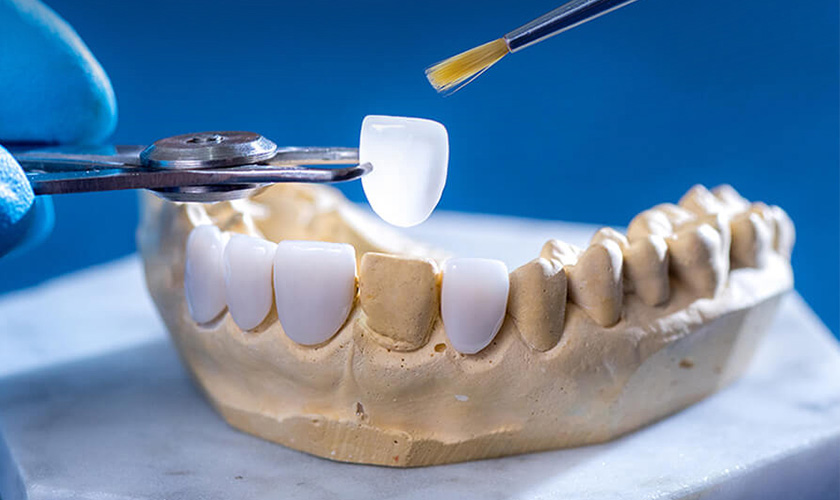 Porcelain veneers with the ultra-thin structure help to restore the teeth naturally