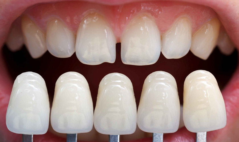 The porcelain veneers with the natural color as the enamel, good glossiness, and reflectivity
